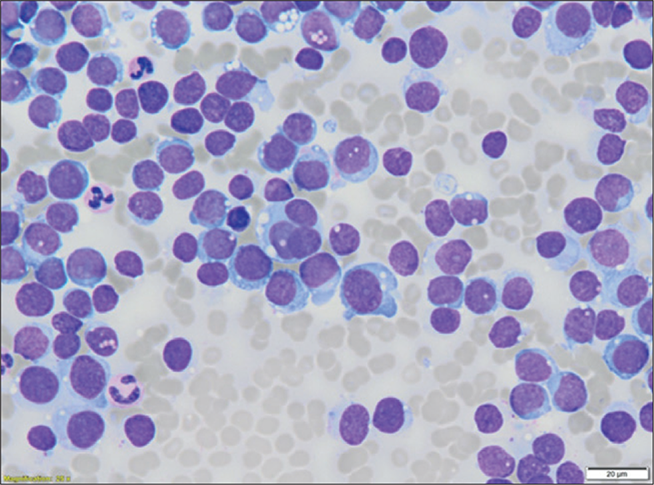 Rhabdomyosarcoma mimicking acute leukaemia diagnosed on bone marrow - BJH