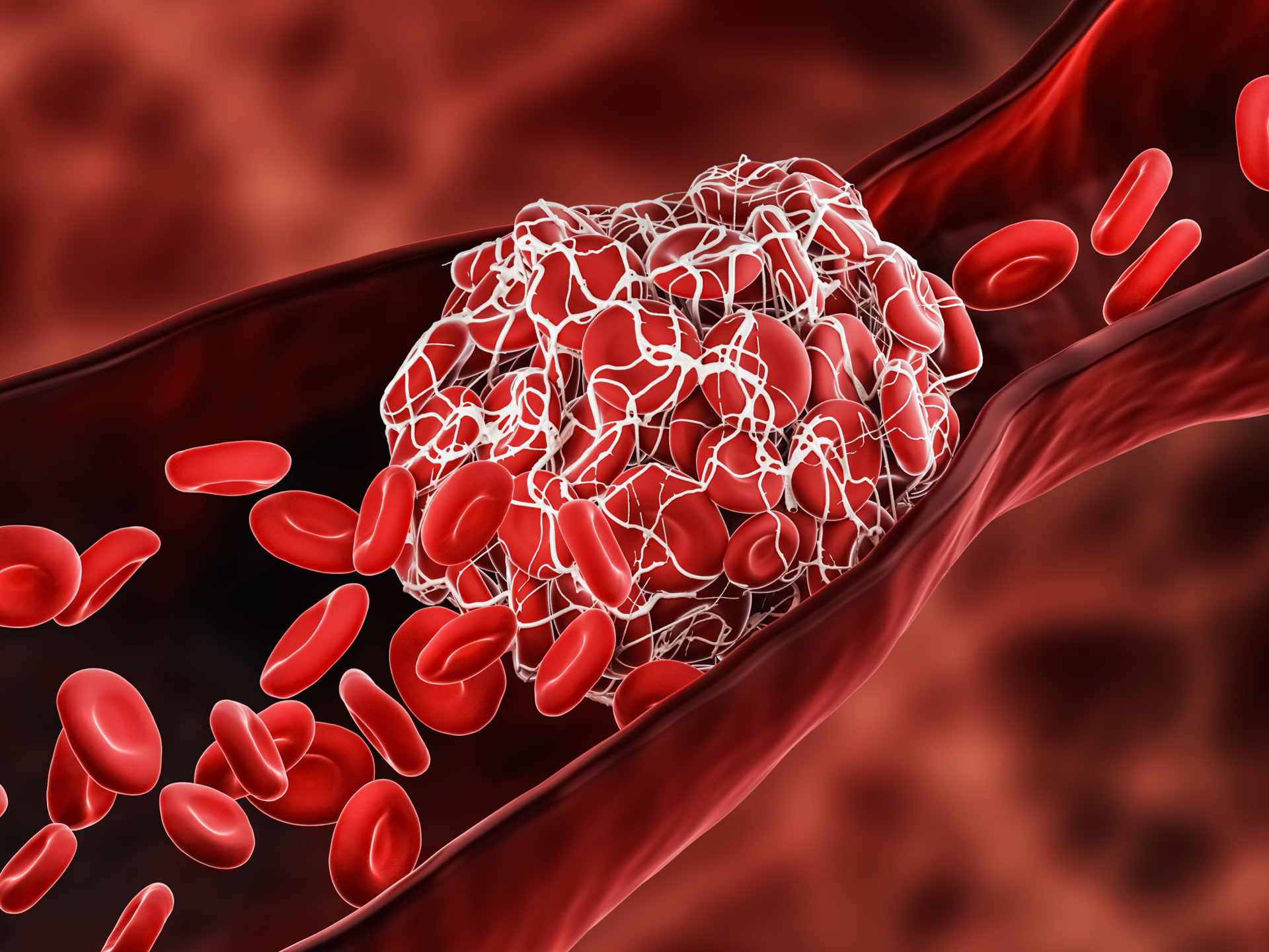 Thrombotic thrombocytopenic purpura (TTP) - BJH