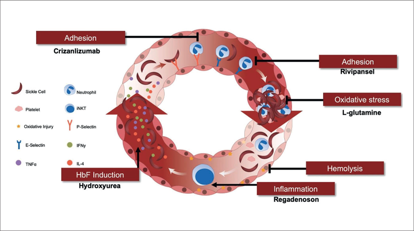 Sickle cell disease for the adult hematologist - BJH